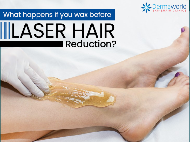 What Happens If You Wax Before Laser Hair Reduction?